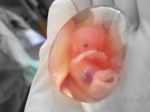This baby died as a result of an actual therapeutic abortion, not "for the mother's mental health."  The mother had cancer of the cervix, and the uterus was removed.  The development seen here is 10 weeks from the mother's last menstrual period.  